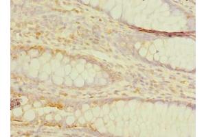 Immunohistochemistry of paraffin-embedded human colon cancer using ABIN7173249 at dilution of 1:100 (TMEM59L antibody  (AA 27-267))