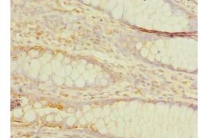 Immunohistochemistry of paraffin-embedded human colon cancer using ABIN7173249 at dilution of 1:100 (TMEM59L antibody  (AA 27-267))