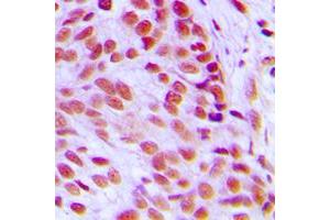 Immunohistochemical analysis of c-FOS staining in human breast cancer formalin fixed paraffin embedded tissue section. (c-FOS antibody  (N-Term))