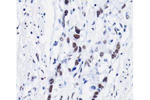 Immunohistochemistry of paraffin-embedded Human gastric cancer using Acetyl-Histone H4-K8 Polyclonal Antibody at dilution of 1:100 (40x lens). (Histone H4 antibody  (acLys8))