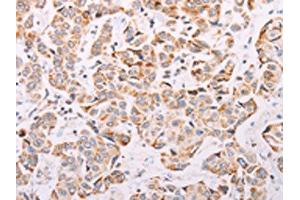 The image on the left is immunohistochemistry of paraffin-embedded Human breast cancer tissue using ABIN7189654(ADAMTS16 Antibody) at dilution 1/50, on the right is treated with synthetic peptide.