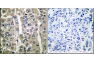 Immunohistochemistry analysis of paraffin-embedded human breast carcinoma tissue, using Involucrin Antibody.
