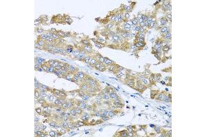 Immunohistochemistry of paraffin-embedded human liver cancer using COQ7 antibody at dilution of 1:100 (x40 lens).