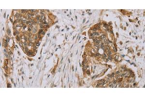 Immunohistochemistry of paraffin-embedded Human esophagus cancer using MVK Polyclonal Antibody at dilution of 1:40 (MVK antibody)