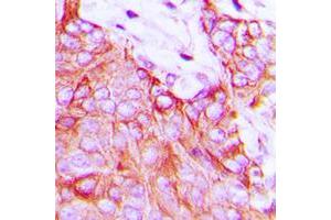 Immunohistochemical analysis of Ephrin A5 staining in human breast cancer formalin fixed paraffin embedded tissue section. (Ephrin A5 antibody  (Center))