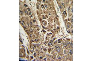 Formalin-fixed and paraffin-embedded human hepatocarcinoma with MTTP Antibody (C-term), which was peroxidase-conjugated to the secondary antibody, followed by DAB staining. (MTTP antibody  (C-Term))