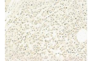ABIN6263911 and ABIN6278220 at 1/100 staining human Hodgkin lymphoma by IHC-P. (OSR1 antibody  (C-Term))