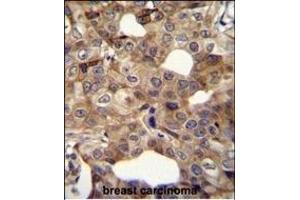 CCNI2 Antibody (Center) (ABIN655840 and ABIN2845254) immunohistochemistry analysis in formalin fixed and paraffin embedded human breast carcinoma followed by peroxidase conjugation of the secondary antibody and DAB staining. (CCNI2 antibody  (AA 92-121))