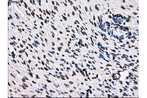 Immunohistochemical staining of paraffin-embedded Adenocarcinoma of breast tissue using anti-TTLL12 mouse monoclonal antibody. (TTLL12 antibody)