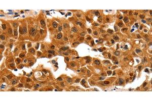 Immunohistochemistry of paraffin-embedded Human lung cancer using 14-3-3 beta/alpha Polyclonal Antibody at dilution of 1:30 (YWHAB antibody)