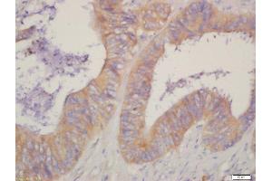 Formalin-fixed and paraffin embedded human cervical cancer labeled with Rabbit Anti-HSD17B1 Polyclonal Antibody, Unconjugated  at 1:200 followed by conjugation to the secondary antibody and DAB staining (HSD17B1 antibody  (AA 21-120))