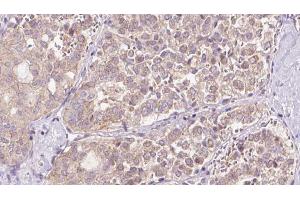 ABIN6273307 at 1/100 staining Human thyroid cancer tissue by IHC-P. (REEP2 antibody  (Internal Region))