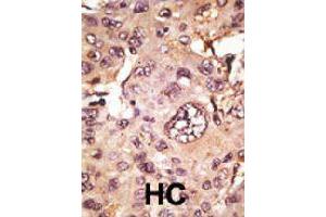 Formalin-fixed and paraffin-embedded human hepatocellular carcinoma tissue reacted with MAPT polyclonal antibody  , which was peroxidase-conjugated to the secondary antibody, followed by AEC staining. (MAPT antibody  (C-Term))