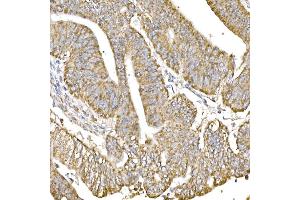 Immunohistochemistry of paraffin-embedded human colon carcinoma using GC1q R/C1QBP antibody (ABIN7266473) at dilution of 1:25 (40x lens). (C1QBP antibody)