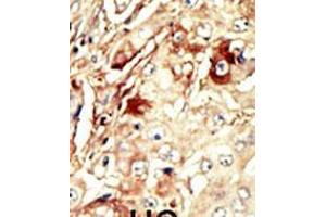 Formalin-fixed and paraffin-embedded human cancer tissue reacted with the primary antibody, which was peroxidase-conjugated to the secondary antibody, followed by AEC staining. (WEE1 antibody  (AA 144-173))