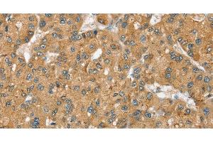 Immunohistochemistry of paraffin-embedded Human liver cancer using SEC14L2 Polyclonal Antibody at dilution of 1:40 (SEC14L2 antibody)