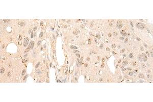 Immunohistochemistry of paraffin-embedded Human esophagus cancer tissue using DDX21 Polyclonal Antibody at dilution of 1:40(x200) (DDX21 antibody)