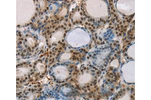 Immunohistochemistry of Human thyroid cancer using RUNX1T1 Polyclonal Antibody at dilution of 1:35