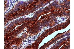 Immunohistochemistry staining of human colon adenocarcinoma (paraffin-embedded sections) with anti-Blood Group Lewis a (7LE). (Blood Group Lewis A antibody)