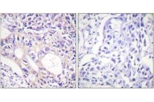 Immunohistochemistry analysis of paraffin-embedded human breast carcinoma, using Aurora Kinase (Phospho-Thr288) Antibody. (Aurora Kinase (AA 256-305), (pThr288) antibody)