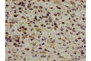 Immunohistochemistry of paraffin-embedded human glioma using ABIN7154609 at dilution of 1:100