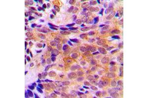 Immunohistochemical analysis of ACOT2 staining in human breast cancer formalin fixed paraffin embedded tissue section. (ACOT2 antibody  (Center))