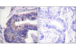 Immunohistochemistry analysis of paraffin-embedded human colon carcinoma tissue, using PDE4D (Ab-190/53) Antibody. (PDE4D antibody  (AA 156-205))