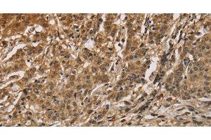 Immunohistochemistry of paraffin-embedded Human gastric cancer using CALU Polyclonal Antibody at dilution of 1:40 (CALU antibody)