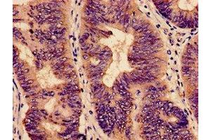 Immunohistochemistry analysis of human colon cancer using ABIN7151715 at dilution of 1:100 (ybeY antibody  (AA 54-167))