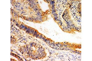 Anti-SLC1A4 antibody, IHC(P) IHC(P): Human Intestinal Cancer Tissue