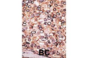 Formalin-fixed and paraffin-embedded human cancer tissue reacted with MAGEA2 polyclonal antibody  , which was peroxidase-conjugated to the secondary antibody, followed by AEC staining. (MAGEA2 antibody  (N-Term))