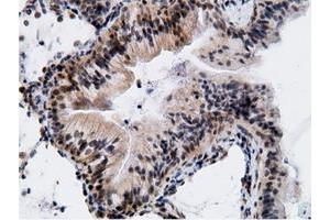 Immunohistochemical staining of paraffin-embedded Adenocarcinoma of Human breast tissue using anti-EPM2AIP1 mouse monoclonal antibody. (EPM2AIP1 antibody)