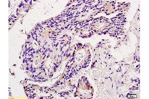 Formalin-fixed and paraffin embedded human colon carcinoma labeled with Anti-MMP9 Polyclonal Antibody, Unconjugated (ABIN873171) at 1:200 followed by conjugation to the secondary antibody and DAB staining. (MMP 9 antibody  (AA 151-250))