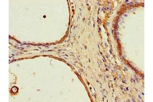 Immunohistochemistry of paraffin-embedded human prostate cancer using ABIN7169623 at dilution of 1:100 (SPPL2A antibody  (AA 26-172))