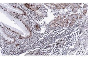 IHC-P Image Immunohistochemical analysis of paraffin-embedded human gastric cancer, using DDX39, antibody at 1:100 dilution. (BAT1 antibody  (Center))