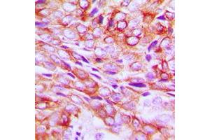 Immunohistochemical analysis of TMBIM1 staining in human breast cancer formalin fixed paraffin embedded tissue section. (TMBIM1 antibody  (C-Term))