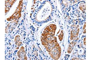 The image on the left is immunohistochemistry of paraffin-embedded Human stomach cancer tissue using ABIN7191274(LIF Antibody) at dilution 1/25, on the right is treated with synthetic peptide. (LIF antibody)