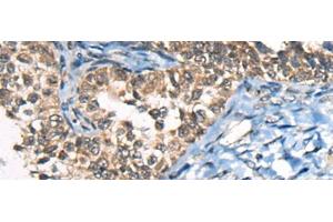 Immunohistochemistry of paraffin-embedded Human ovarian cancer tissue using CDKL4 Polyclonal Antibody at dilution of 1:45(x200) (CDKL4 antibody)