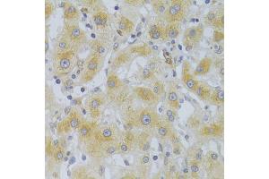 Immunohistochemistry of paraffin-embedded human liver cancer using EIF4G1 Antibody (ABIN5975844) at dilution of 1/100 (40x lens). (EIF4G1 antibody)