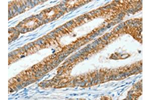 The image on the left is immunohistochemistry of paraffin-embedded Human colon cancer tissue using ABIN7128299(AGR3 Antibody) at dilution 1/15, on the right is treated with fusion protein. (AGR3 antibody)