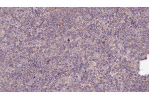 ABIN6273142 at 1/100 staining Human lymph cancer tissue by IHC-P. (Myosin XVIIIA antibody  (Internal Region))