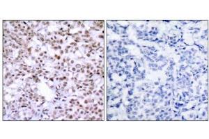 Immunohistochemical analysis of paraffin-embedded human breast carcinoma tissue using Chk2 (Ab-68) antibody (E021087). (CHEK2 antibody)