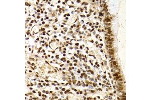 Immunohistochemistry of paraffin-embedded human gastric cancer using XRCC4 Antibody. (XRCC4 antibody)