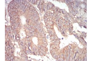 Immunohistochemical analysis of paraffin-embedded rectum cancer tissues using 1-193 mouse mAb with DAB staining. (alpha Adducin antibody  (AA 1-193))
