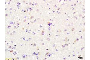 Formalin-fixed and paraffin embedded human glioma labeled with Anti-MIF Polyclonal Antibody, Unconjugated  at 1:200 followed by conjugation to the secondary antibody and DAB staining. (MIF antibody  (AA 51-115))