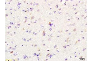 Formalin-fixed and paraffin embedded human glioma labeled with Anti-MIF Polyclonal Antibody, Unconjugated  at 1:200 followed by conjugation to the secondary antibody and DAB staining.
