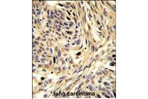 Formalin-fixed and paraffin-embedded human lung carcinoma reacted with HSPD1 Antibody (C-term), which was peroxidase-conjugated to the secondary antibody, followed by DAB staining. (HSPD1 antibody  (C-Term))
