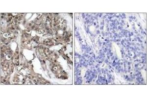 Immunohistochemistry analysis of paraffin-embedded human breast carcinoma tissue, using Akt (Ab-308) Antibody. (AKT1 antibody  (AA 276-325))