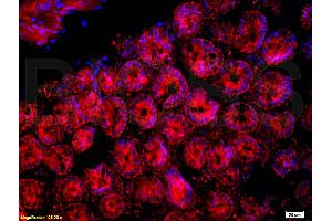 Formalin-fixed and paraffin embedded human gastric carcinoma labeled with Rabbit Anti CD33/Siglec-3 Polyclonal Antibody, Unconjugated at 1:200 followed by conjugation to the secondary antibody and DAB staining (CD33 antibody  (AA 101-200))