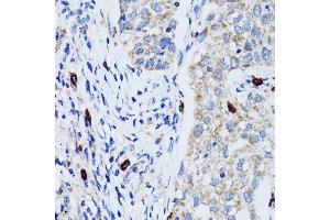 Immunohistochemistry of paraffin-embedded human lung cancer using MAP1LC3B antibody. (LC3B antibody)